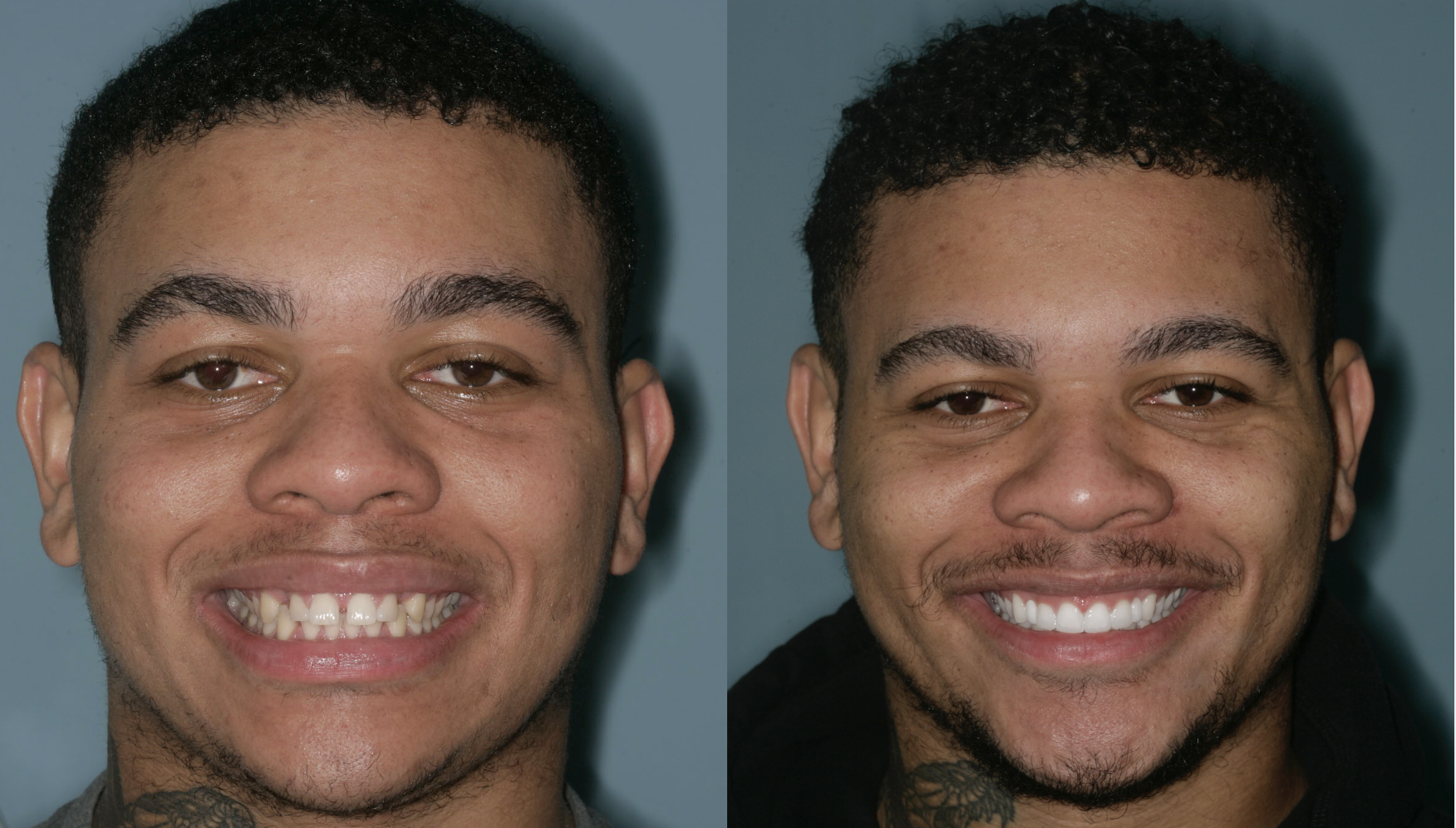 Chris — Invisalign