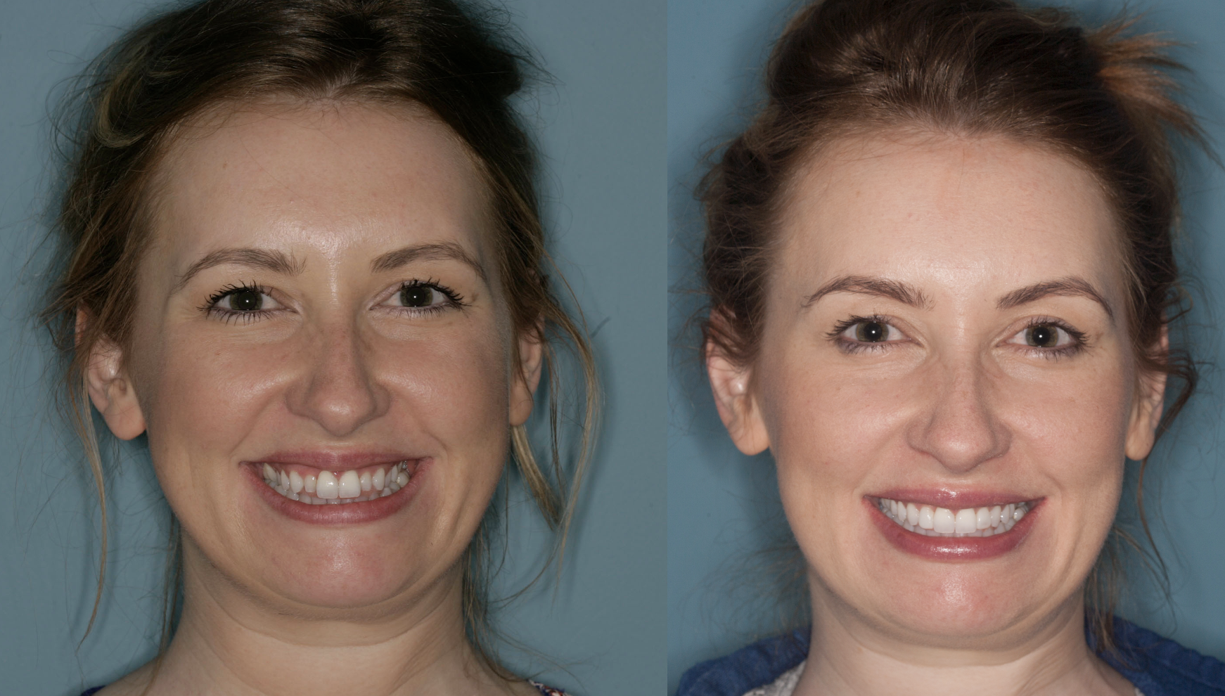 Sam — Invisalign